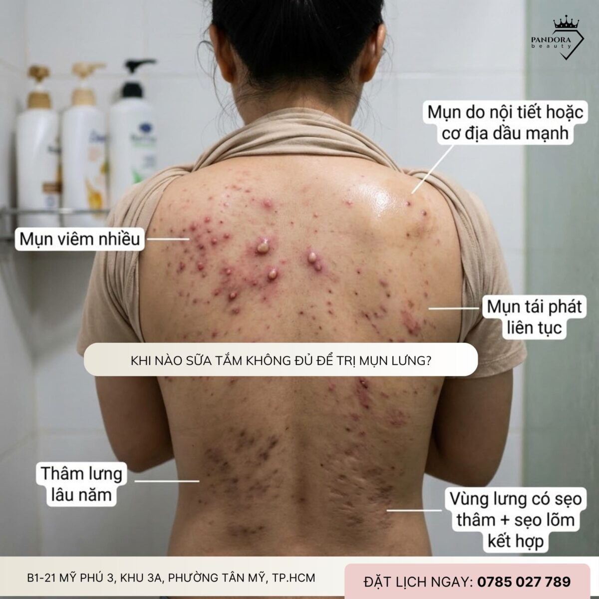 Trị mụn lưng: Sữa tắm trị mụn lưng có thật sự hiệu quả không?