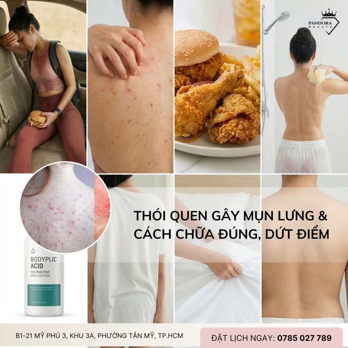 Trị mụn lưng: Thói quen gây mụn lưng & cách chữa đúng, dứt điểm