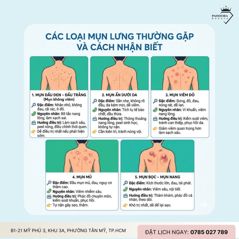 Phân biệt và điều trị mụn lưng các loại: Hiểu đúng mụn – trị mụn lưng mới hiệu quả