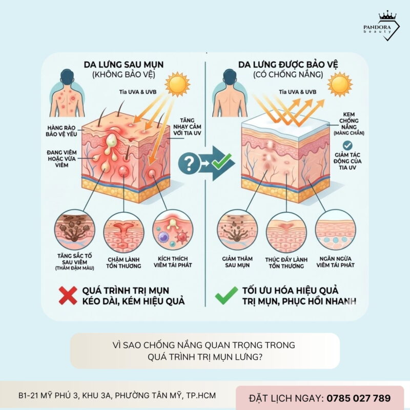 Trị mụn lưng: Có cần dùng kem chống nắng cho vùng lưng không?