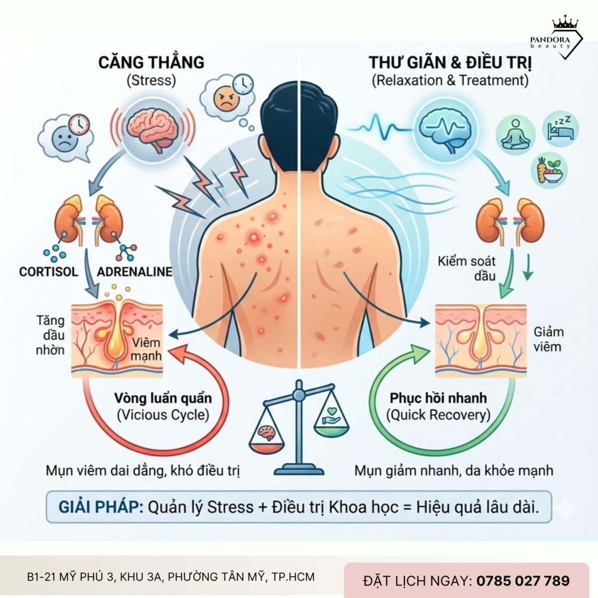 Trị mụn lưng và stress: Vì sao càng căng thẳng, mụn càng lâu khỏi?