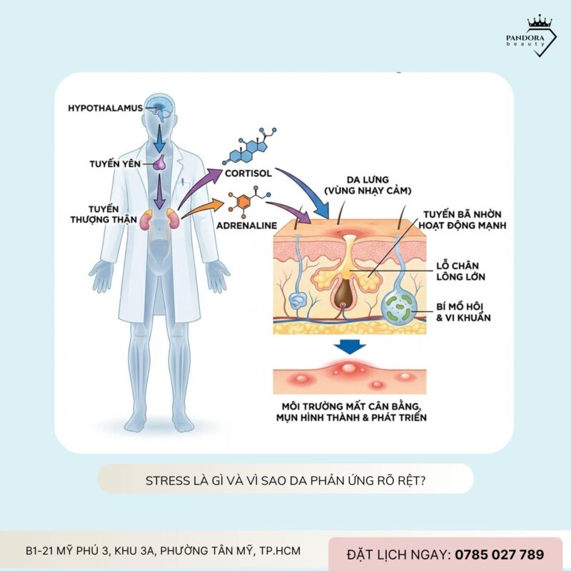 Trị mụn lưng và stress: Vì sao càng căng thẳng, mụn càng lâu khỏi?