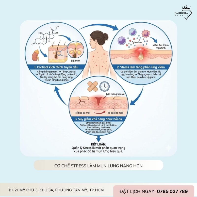 Trị mụn lưng và stress: Vì sao càng căng thẳng, mụn càng lâu khỏi?