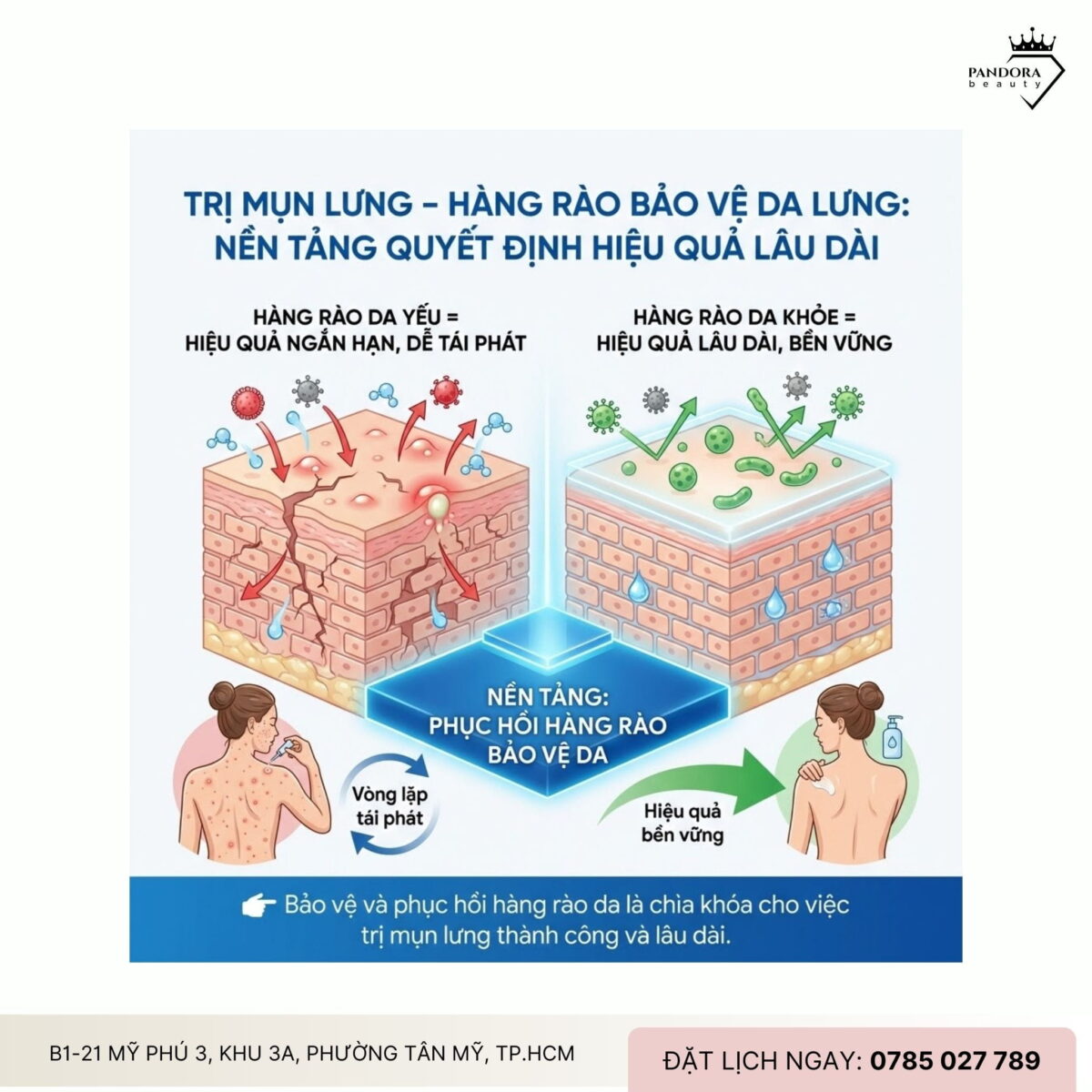 Trị mụn lưng – Hàng rào bảo vệ da lưng: Nền tảng quyết định hiệu quả lâu dài