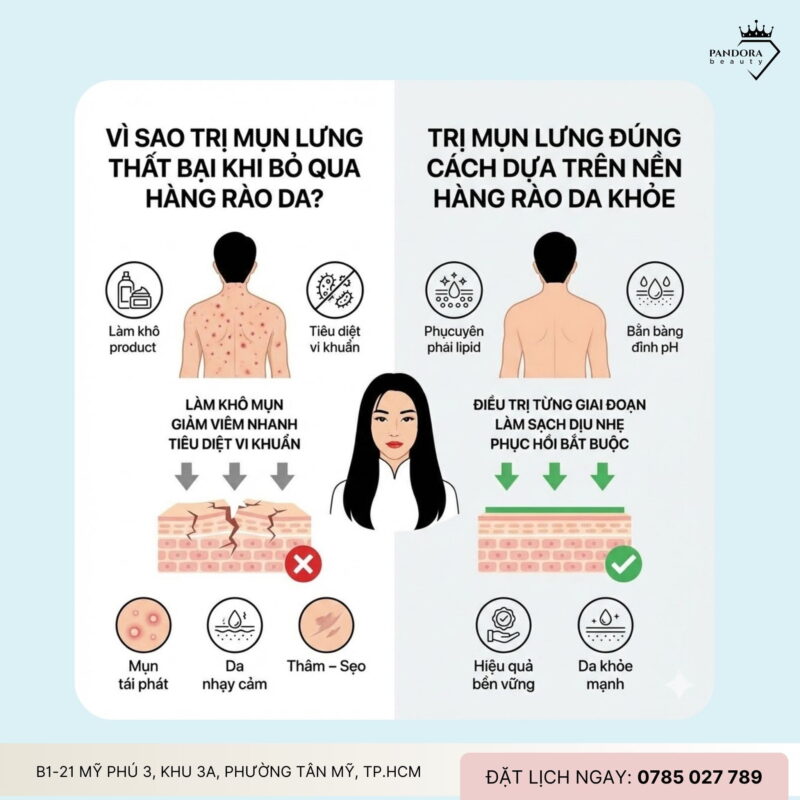 Trị mụn lưng - Hàng rào bảo vệ da lưng: Nền tảng quyết định hiệu quả lâu dài