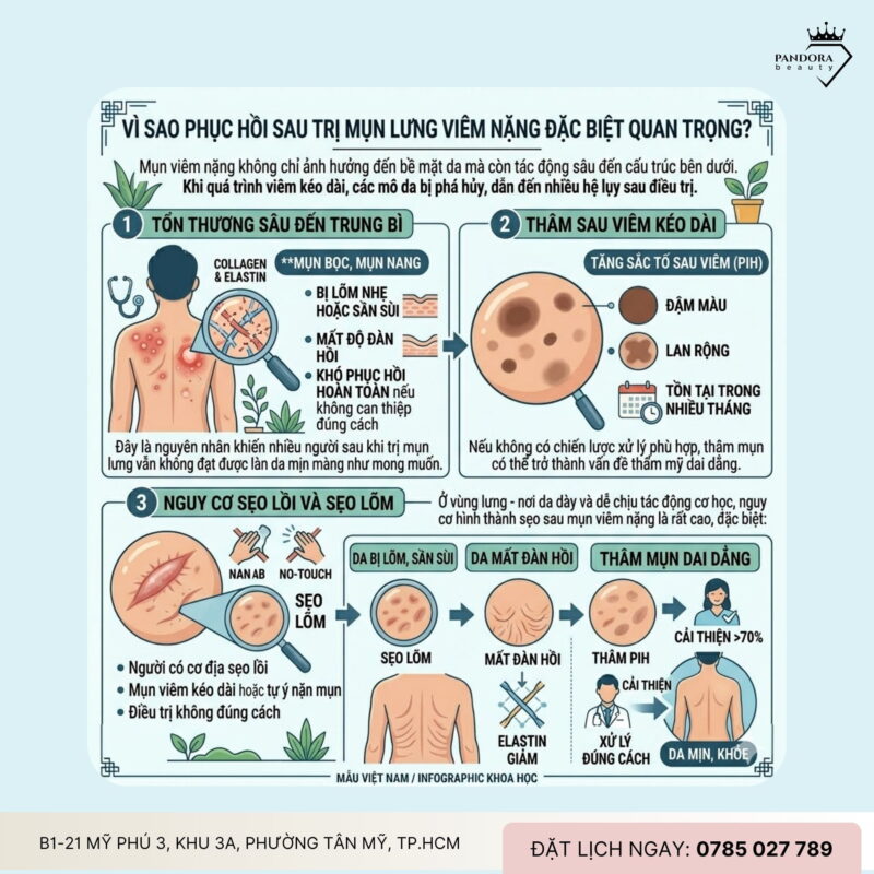 Trị mụn lưng viêm nặng & phục hồi sau điều trị: Lộ trình tái thiết nền da an toàn, bền vững