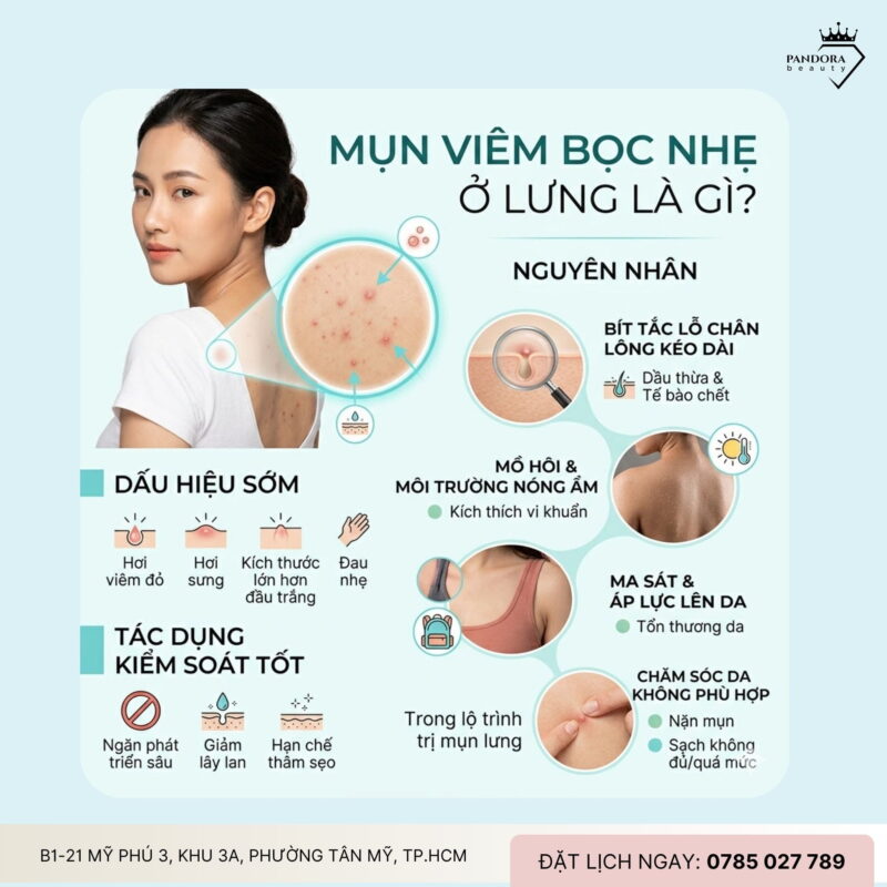 Trị mụn lưng viêm bọc nhẹ: Xử lý sớm để ngăn tiến triển và hạn chế thâm sẹo